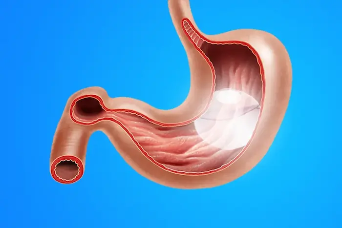 Mide Balonu Nedir?